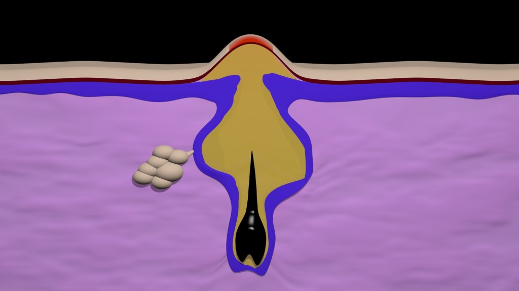 Acne formation