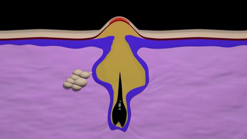 Acne formation